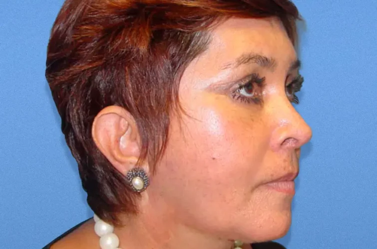 Dual view of facelift results in Cancun – patient 3