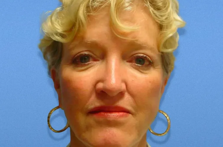 Facelift Cancun Before Image | Patient 1 Front View