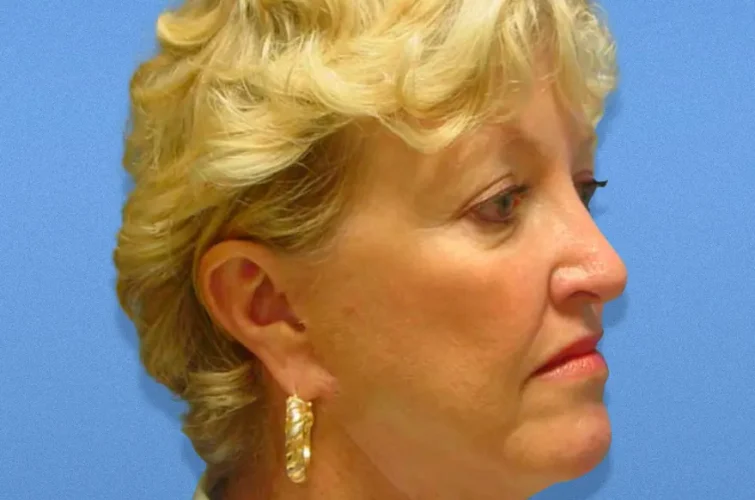 Text: Pre-op facelift image – patient 1 Cancun front/profile