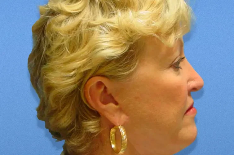 Side profile before facelift – Cancun rhytidectomy patient 1