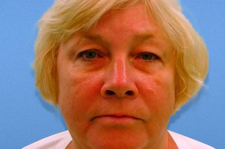 Before facelift photo – Cancun rhytidectomy patient 2