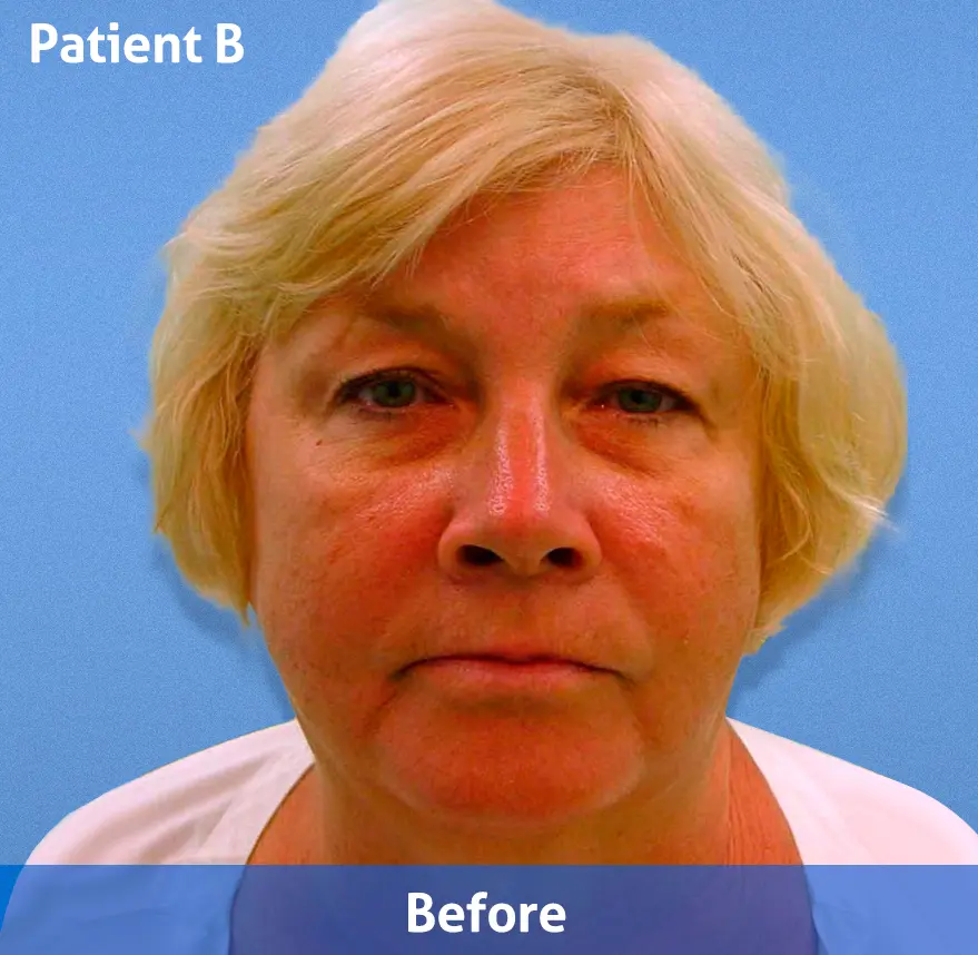 Facelift
