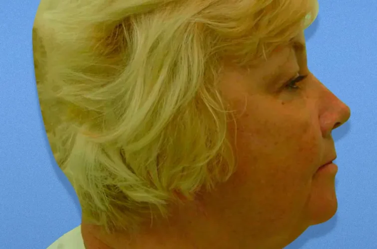 Profile image of patient 2 before facelift Cancun