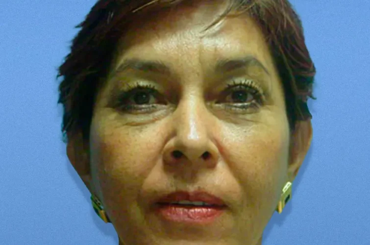 Patient 3 before rhytidectomy in Cancun – front view