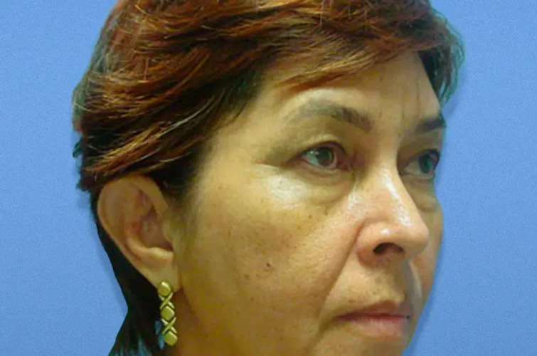 Front and profile before facelift – Cancun patient 3