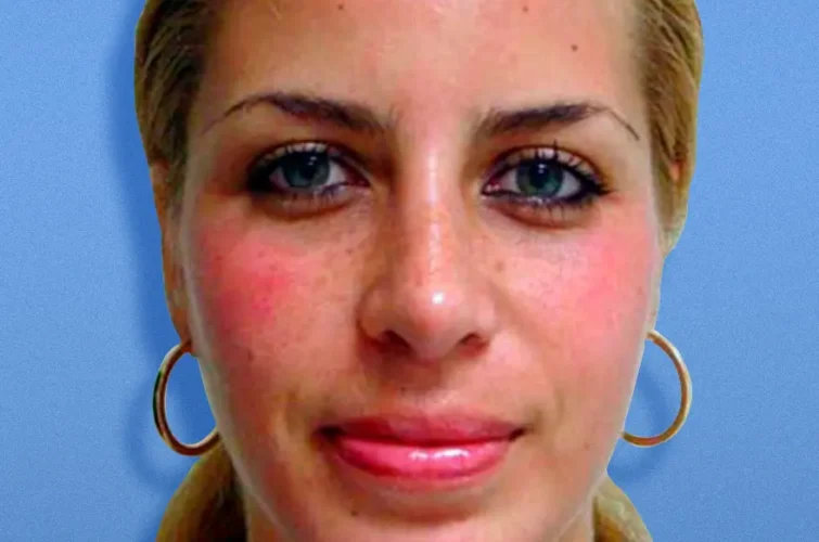Rhinoplasty results in Cancun – Frontal view after nose reshaping (Patient A)