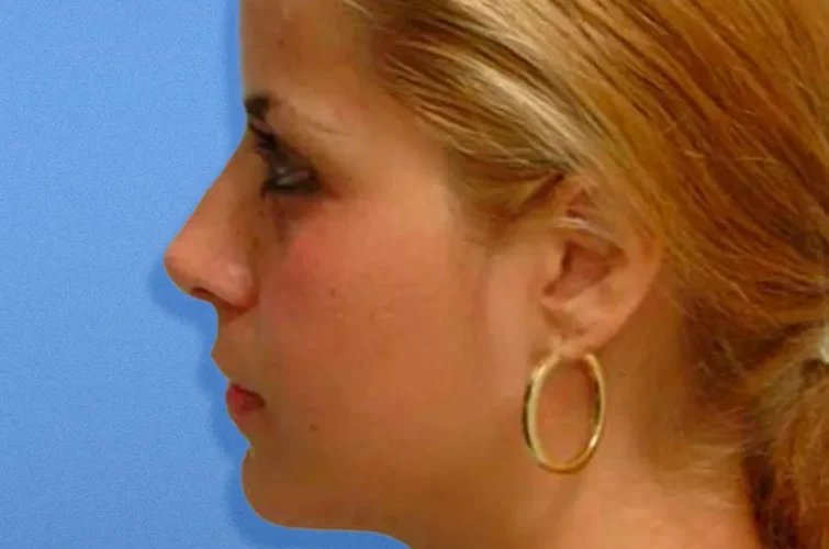 Rhinoplasty in Mexico – Patient A after surgery, left profile view