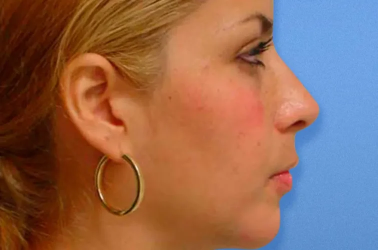 Rhinoplasty Cancun – After image right profile (Patient A)
