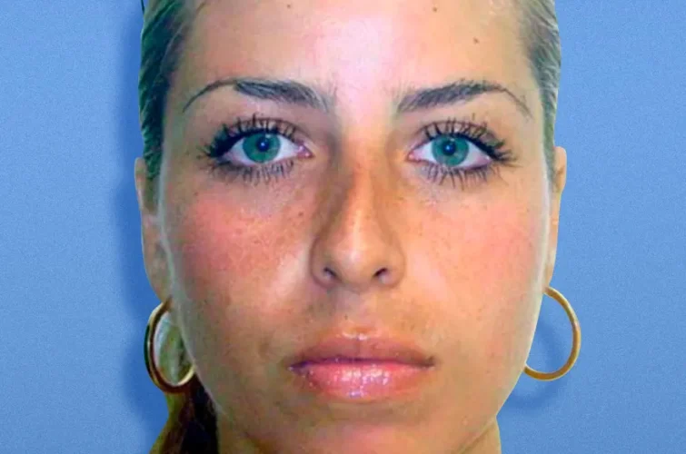 Rhinoplasty in Cancun – Patient A frontal image before nasal surgery