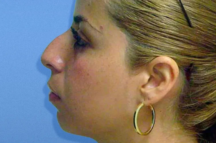 Rhinoplasty in Cancun – Left side profile before nasal correction (Patient A)