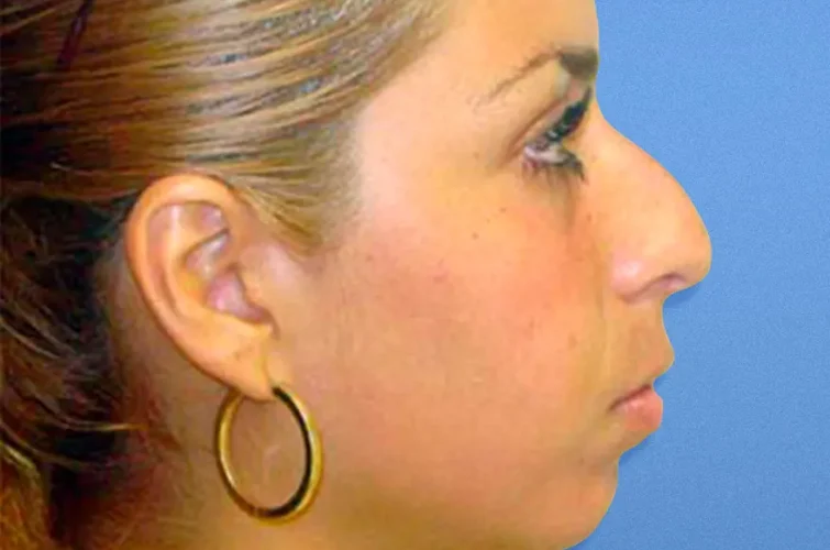 Nose surgery Cancun – Patient A before rhinoplasty (right profile)