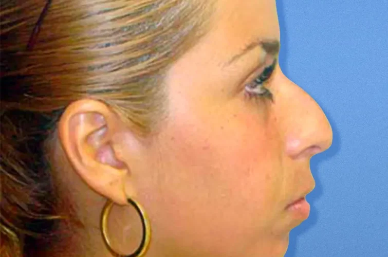 Nose surgery Cancun – Patient A before rhinoplasty (right profile)