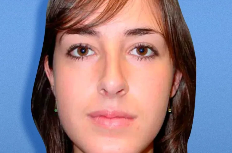 Rhinoplasty outcome Cancun – Patient B frontal view after surgery