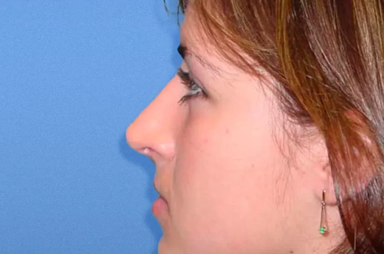Nose reshaping surgery Cancun – Patient B after rhinoplasty, left side