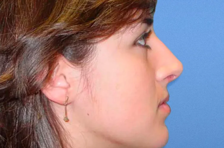 Patient B rhinoplasty results in Mexico – Right side after surgery