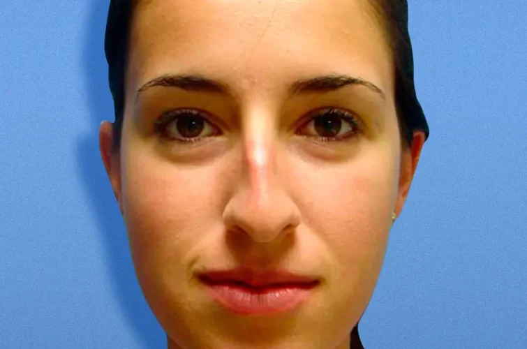 Rhinoplasty in Cancun Mexico – Patient B frontal view before surgery