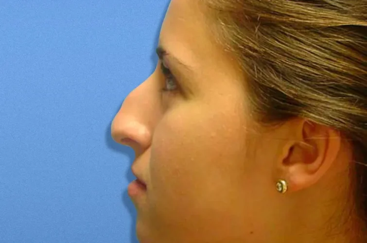 Nose surgery before image – Patient B left profile (Cancun)