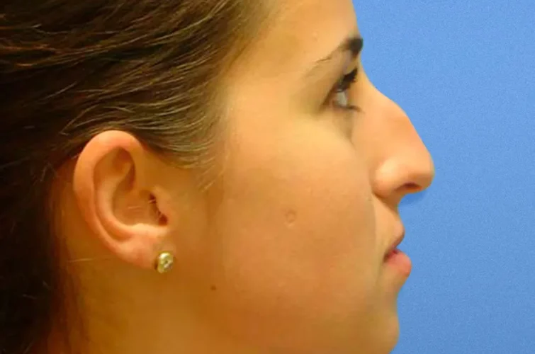 Rhinoplasty Mexico – Patient B right profile before nose surgery