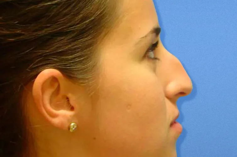Rhinoplasty Mexico – Patient B right profile before nose surgery