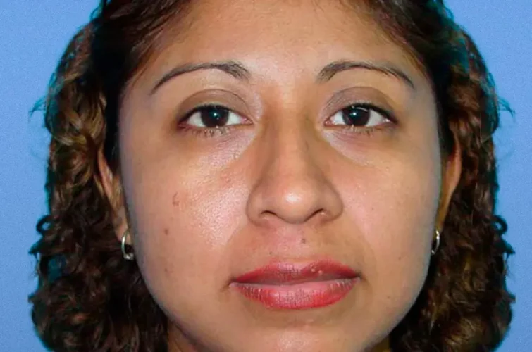 Rhinoplasty Cancun – Patient C frontal view before surgery